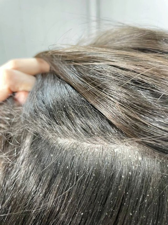 Nguy cơ tóc rụng lả tả vì nắng: 6 dấu hiệu không thể bỏ qua!- Ảnh 2. Nguy cơ tóc rụng lả tả vì nắng: 6 dấu hiệu không thể bỏ qua!- Ảnh 2.