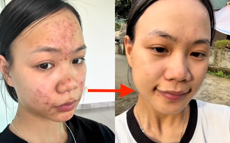 Da chi chít mụn do 5 năm rửa mặt sai cách, cô nàng chữa lành làn da bằng loại hạt mà mọi người vứt bỏ- Ảnh 16. Da chi chít mụn do 5 năm rửa mặt sai cách, cô nàng chữa lành làn da bằng loại hạt mà mọi người vứt bỏ- Ảnh 16.