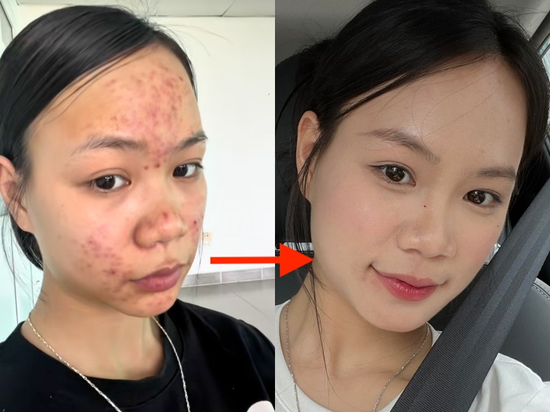 Da chi chít mụn do 5 năm rửa mặt sai cách, cô nàng chữa lành làn da bằng loại hạt mà mọi người vứt bỏ- Ảnh 17. Da chi chít mụn do 5 năm rửa mặt sai cách, cô nàng chữa lành làn da bằng loại hạt mà mọi người vứt bỏ- Ảnh 17.