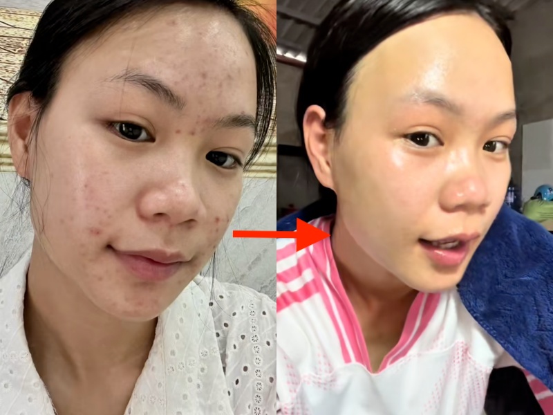 Da chi chít mụn do 5 năm rửa mặt sai cách, cô nàng chữa lành làn da bằng loại hạt mà mọi người vứt bỏ- Ảnh 9. Da chi chít mụn do 5 năm rửa mặt sai cách, cô nàng chữa lành làn da bằng loại hạt mà mọi người vứt bỏ- Ảnh 9.