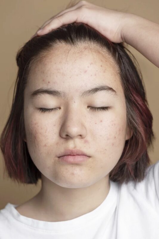 Hướng dẫn dùng Retinol đúng cách, da bị nổi mụn khi dùng có phải là điều bình thường? 1 Hướng dẫn dùng Retinol đúng cách, da bị nổi mụn khi dùng có phải là điều bình thường? huong dan dung retinol dung cach da bi noi mun khi dung co phai la dieu binh thuong