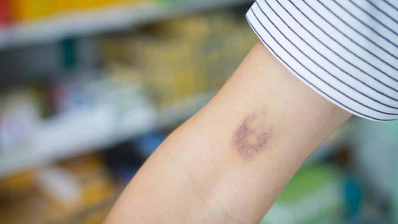 Lý do vitamin K có tác dụng chống lão hóa và dấu hiệu cho thấy bạn đang bị thiếu vitamin này: 2 độ tuổi đặc biệt cần bổ sung- Ảnh 5. Lý do vitamin K có tác dụng chống lão hóa và dấu hiệu cho thấy bạn đang bị thiếu vitamin này: 2 độ tuổi đặc biệt cần bổ sung- Ảnh 5.