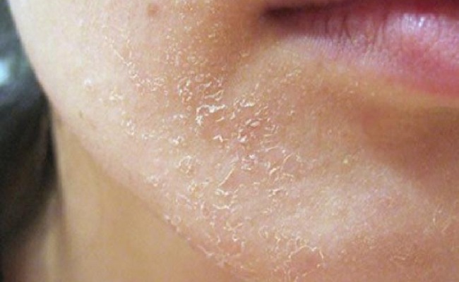 Sai lầm tồi tệ khi dùng Retinol suýt banh mặt, từ đáy lòng khuyên bạn đừng dẫm vào "vết xe đổ" này sai lam toi te khi dung retinol suyt banh mat tu day long khuyen ban dung dam vao vet xe do nay