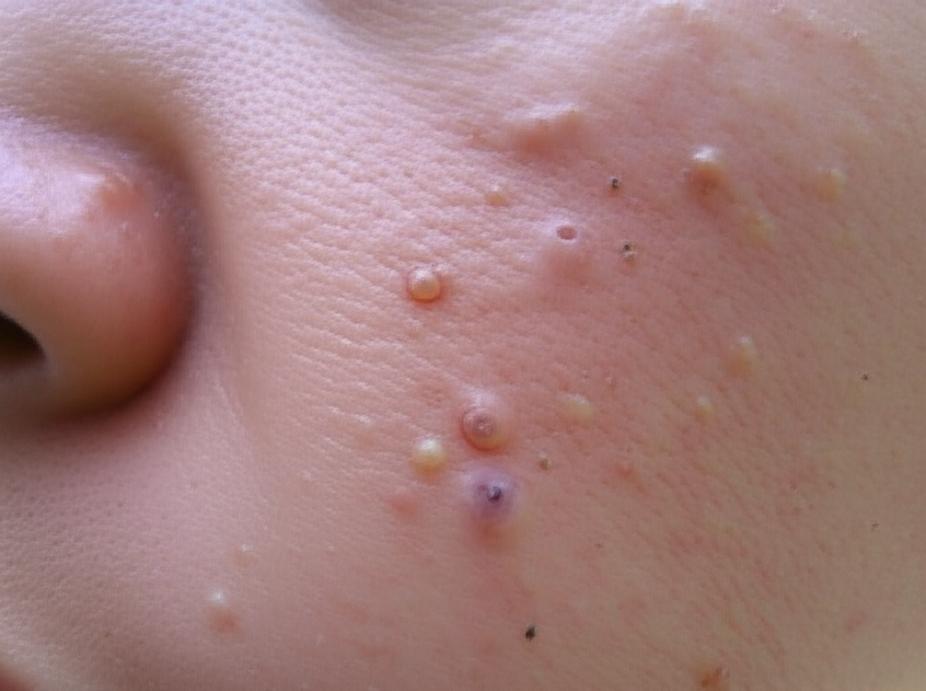 Da Mụn 2026: Nhận Biết, Điều Trị & Ngăn Ngừa Tái Phát da mun nhan biet dieu tri ngan ngua tai phat