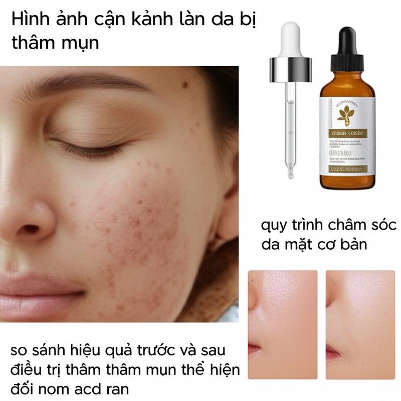 Thâm Mụn 2026: 10+ Giải Pháp Điều Trị Hiệu Quả Tại Nhà, Spa tham mun 2026 giai phap dieu tri hieu qua