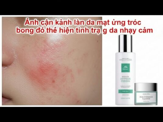 Bài viết da nhay cam nguyen nhan dau hieu cham soc 2026